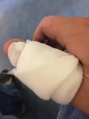 A close up shot of my heavily-bandaged thumb.